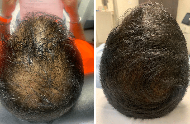 Platelet rich plasma for hair growth, Platelet Rich Plasma for Hair Restoration