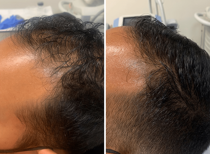 Platelet rich plasma for hair growth, Platelet Rich Plasma for Hair Restoration